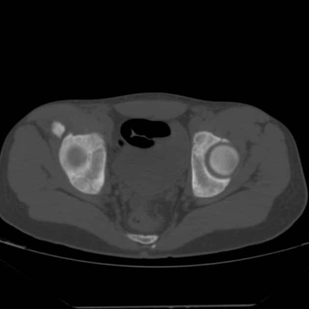 Anterior inferior iliac spine avulsion fracture (Radiopaedia 49469-54627 Axial bone window 35).jpg