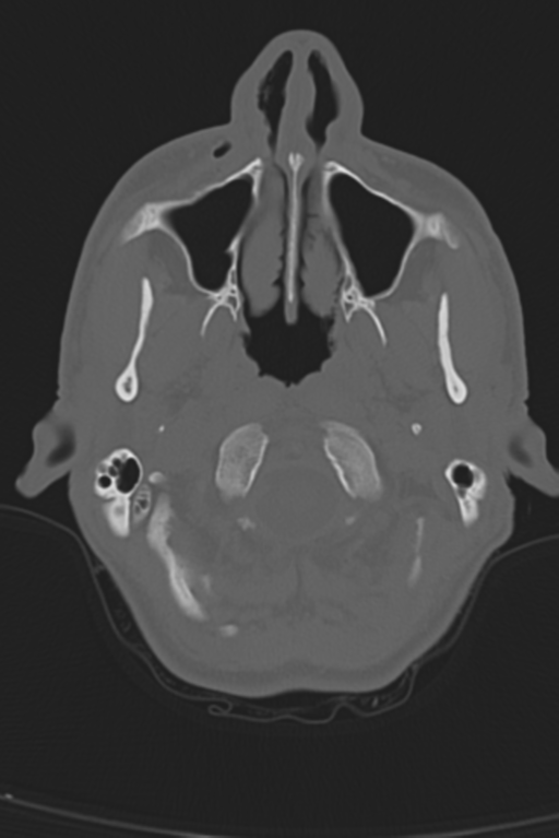 Anterior nasal spine fracture (Radiopaedia 46138-50494 Axial bone window 53).png