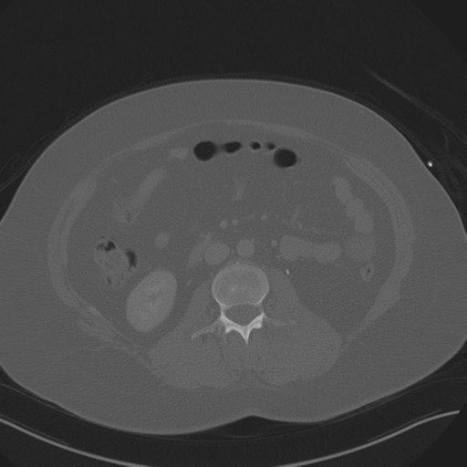 File:Anterior superior iliac spine avulsion fracture (Radiopaedia 44541-48244 Axial bone window 48).png