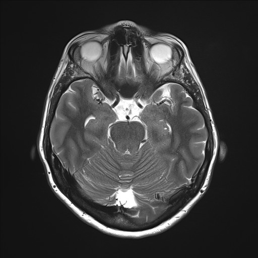 File:Anterior temporal encephalocele (Radiopaedia 82624-96808 Axial T2 13).jpg