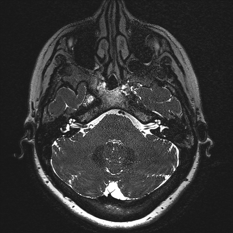 Anterior temporal encephalocele (Radiopaedia 82624-96808 Axial T2 high res 12).jpg