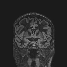 Anterior temporal encephalocele (Radiopaedia 82624-96808 Coronal FLAIR 20).jpg
