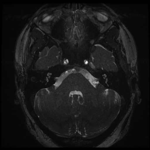 Anterior temporal lobe perivascular space (Radiopaedia 68481-78041 E 8).png