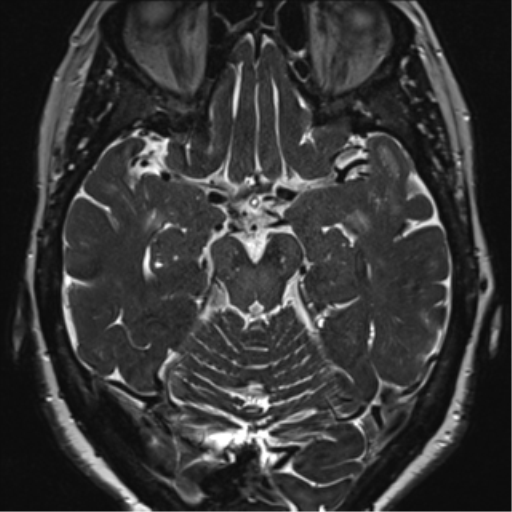 Anterior temporal pole cysts (Radiopaedia 46629-51102 Axial 45).png