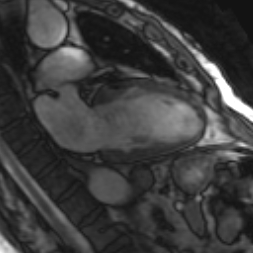 File:Anteroseptal hypokinesia after myocardial infarction (Radiopaedia 15978-15633 2 chamber view SSFE 14).jpg