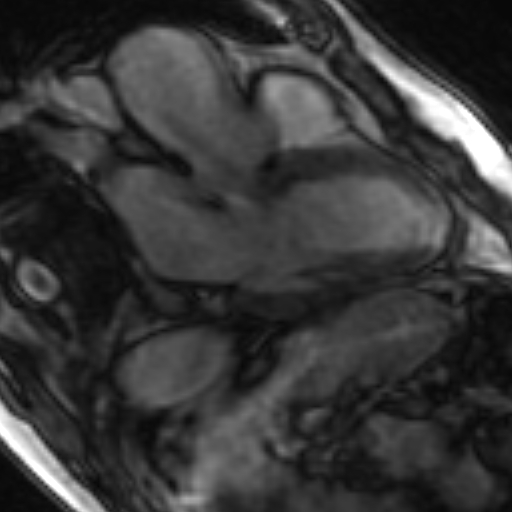 File:Anteroseptal hypokinesia after myocardial infarction (Radiopaedia 15978-15633 3 chamber view SSFE 12).jpg