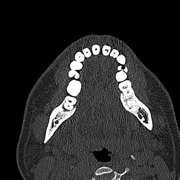 Antrochoanal polyp (Radiopaedia 30002-30554 Axial bone window 7).jpg