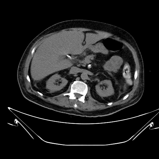 Aortic arch aneurysm (Radiopaedia 84109-99365 Axial non-contrast 307).jpg