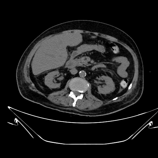 File:Aortic arch aneurysm (Radiopaedia 84109-99365 Axial non-contrast 333).jpg