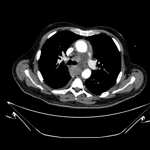 Aortic arch aneurysm (Radiopaedia 84109-99365 B 252).jpg