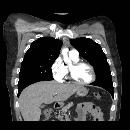 File:Aortic arch stent (Radiopaedia 30030-30595 F 2).jpg