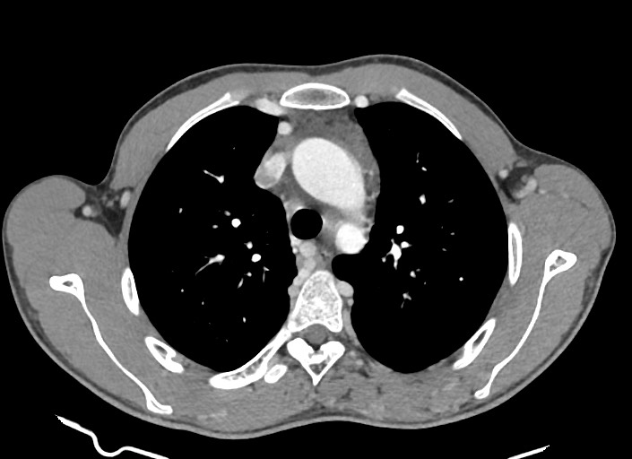 File:Aortic coarctation with aneurysm (Radiopaedia 74818-85828 A 144).jpg