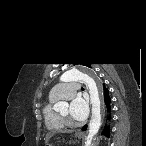 File:Aortic dissection- Stanford A (Radiopaedia 35729-37268 D 15).jpg