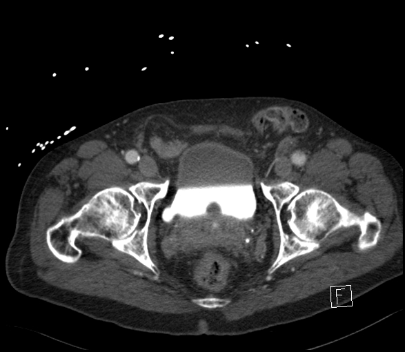 Aortic dissection (CTPA) (Radiopaedia 75506-86750 E 144).jpg