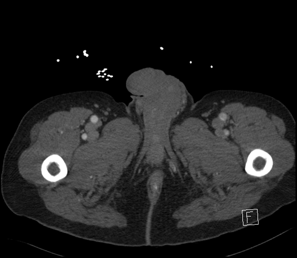 Aortic dissection (CTPA) (Radiopaedia 75506-86750 E 172).jpg