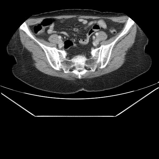 Aortic dissection (Radiopaedia 25350-25604 C 85).jpg