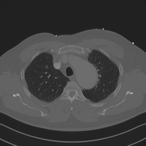 File:Aortic dissection (Radiopaedia 50763-56234 Axial bone window 32).png