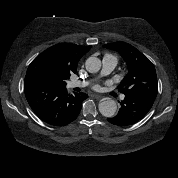 Aortic dissection (Radiopaedia 57969-64959 A 151).jpg