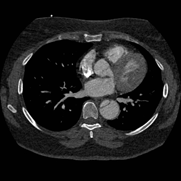 File:Aortic dissection (Radiopaedia 57969-64959 A 181).jpg