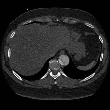 Aortic dissection (Radiopaedia 57969-64959 A 252).jpg