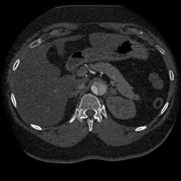 Aortic dissection (Radiopaedia 57969-64959 A 333).jpg