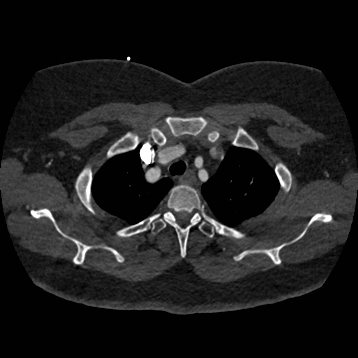 Aortic dissection (Radiopaedia 57969-64959 A 61).jpg