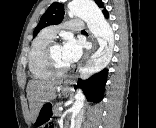 Aortic dissection - Stanford A -DeBakey I (Radiopaedia 28339-28587 C 49).jpg