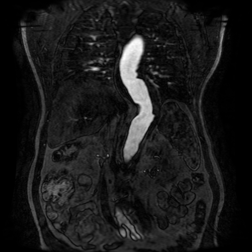 File:Aortic dissection - Stanford A - DeBakey I (Radiopaedia 23469-23551 D 151).jpg