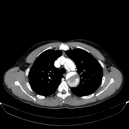 Aortic dissection - Stanford type A (Radiopaedia 83418-98500 A 20).jpg