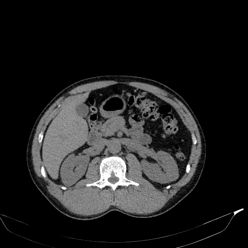 Aortic dissection - Stanford type A (Radiopaedia 83418-98500 Axial non-contrast 51).jpg