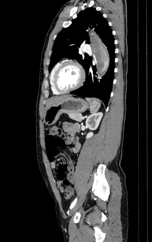 Aortic dissection - Stanford type A (Radiopaedia 83418-98500 B 65).jpg