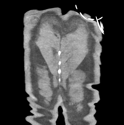 Aortic dissection - Stanford type B (Radiopaedia 50171-55512 B 84).png