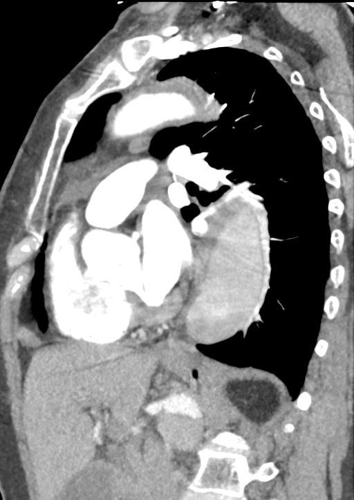 Aortic dissection - Stanford type B (Radiopaedia 50171-55512 C 22).png
