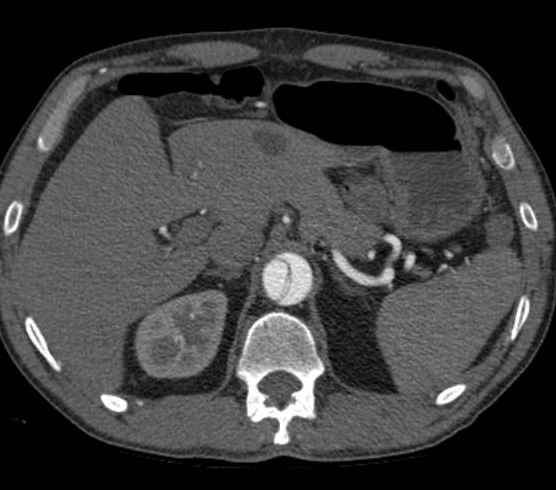 Aortic dissection - Stanford type B (Radiopaedia 73648-84437 A 120).jpg