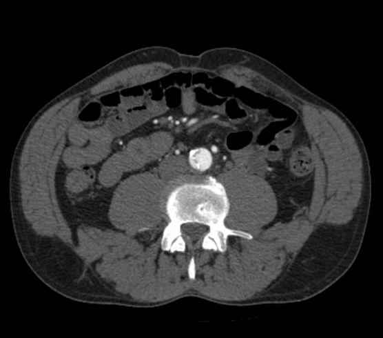 Aortic dissection - Stanford type B (Radiopaedia 73648-84437 A 183).jpg