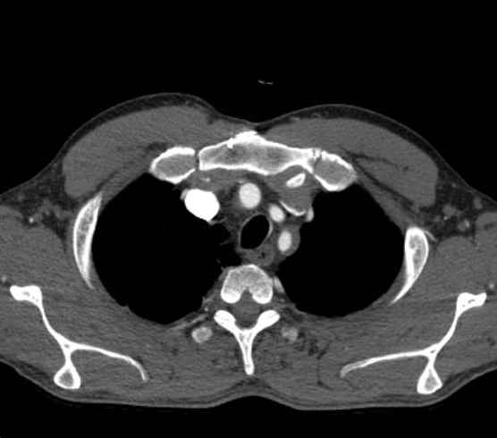 Aortic dissection - Stanford type B (Radiopaedia 73648-84437 A 4).jpg