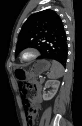 File:Aortic dissection - Stanford type B (Radiopaedia 73648-84437 C 42).jpg