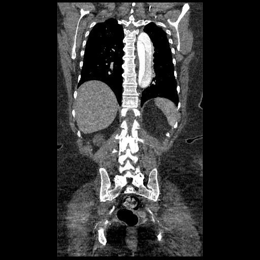 File:Aortic dissection - Stanford type B (Radiopaedia 88281-104910 B 66).jpg