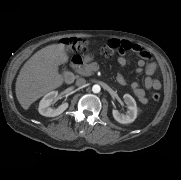 Aortic dissection with rupture into pericardium (Radiopaedia 12384-12647 A 61).jpg