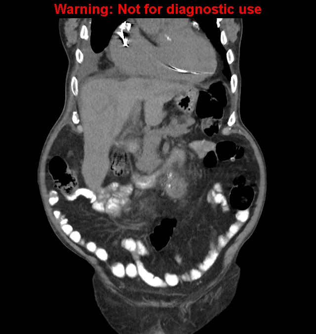 Aortic graft infection (Radiopaedia 44979-48907 non-contrast 16).jpg