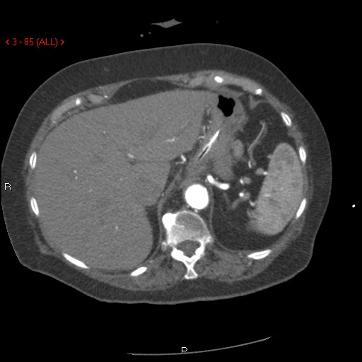 Aortic intramural hematoma (Radiopaedia 27746-28001 A 85).jpg