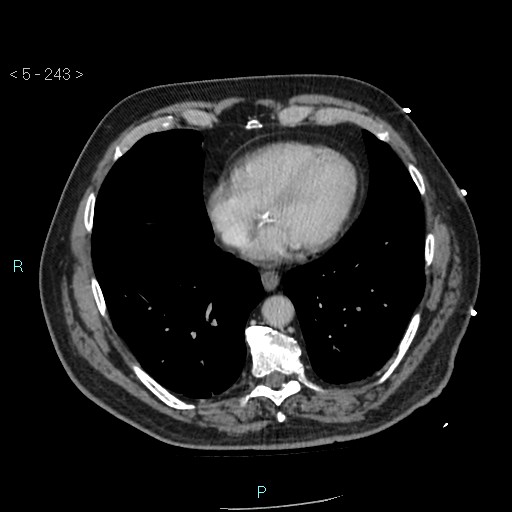 Aortic intramural hematoma (Radiopaedia 48463-53380 C 109).jpg