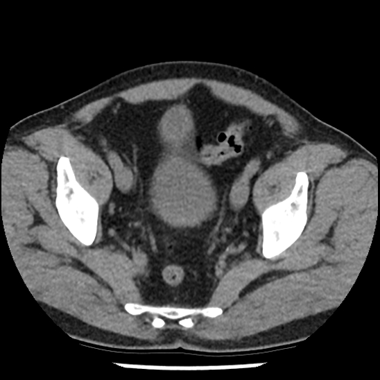Aortic intramural hematoma (type B) (Radiopaedia 79323-92387 Axial non-contrast 103).jpg