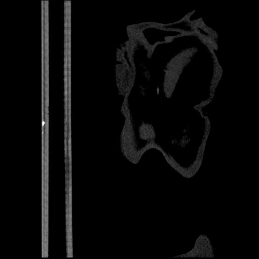 File:Aortic intramural hematoma from penetrating atherosclerotic ulcer (Radiopaedia 31137-31836 C 71).jpg