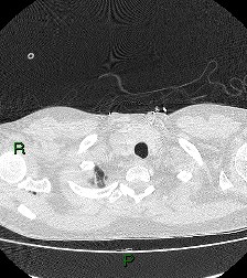 File:Aortic valve endocarditis (Radiopaedia 87209-103485 Axial lung window 13).jpg