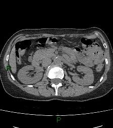 Aortic valve endocarditis (Radiopaedia 87209-103485 Axial non-contrast 109).jpg
