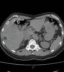 Aortic valve endocarditis (Radiopaedia 87209-103485 Axial non-contrast 96).jpg