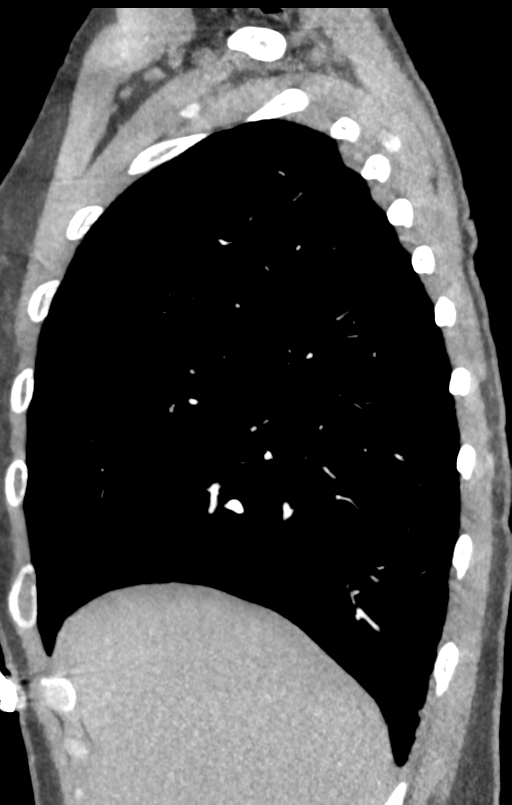 Aortic valve non-coronary cusp thrombus (Radiopaedia 55661-62189 C+ arterial phase 58).png