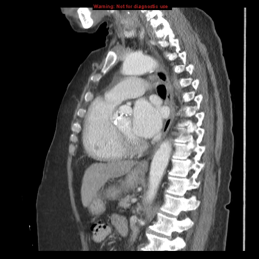 File:Aortic valve stenosis (Radiopaedia 14480-14423 B 5).jpg