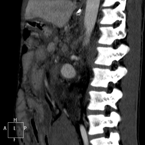 Aorto-left renal vein fistula (Radiopaedia 45534-49628 C 42).jpg
